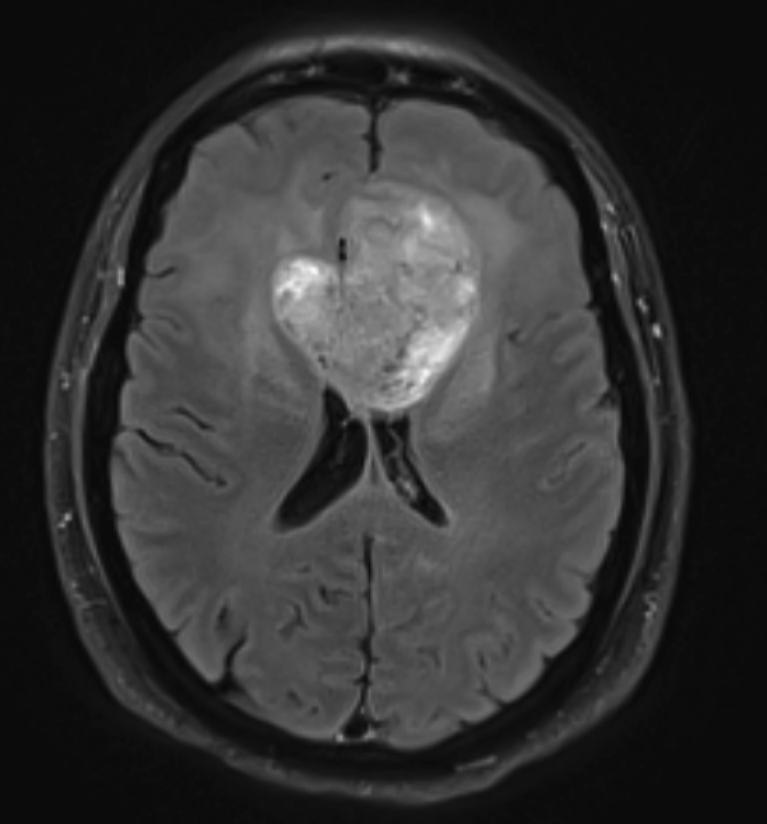 Time matters when moving and growing fast: predicting glioblastoma prognosis and clinical outcome in a patient-specific manner