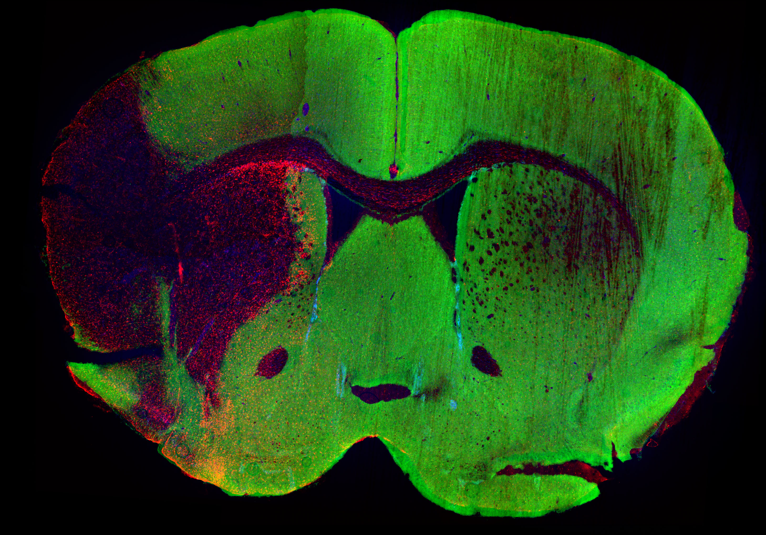 Targeting the HIV-infected brain to improve ischemic stroke outcome