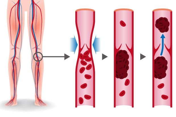 Deep vein thrombosis: symptoms, causes and management