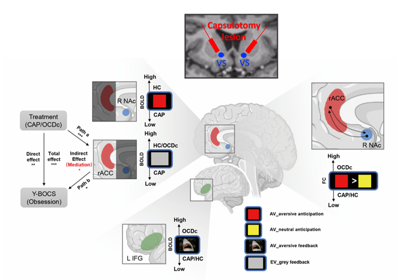 Functional correlates of OCD capsulotomy implicate negative affect processing