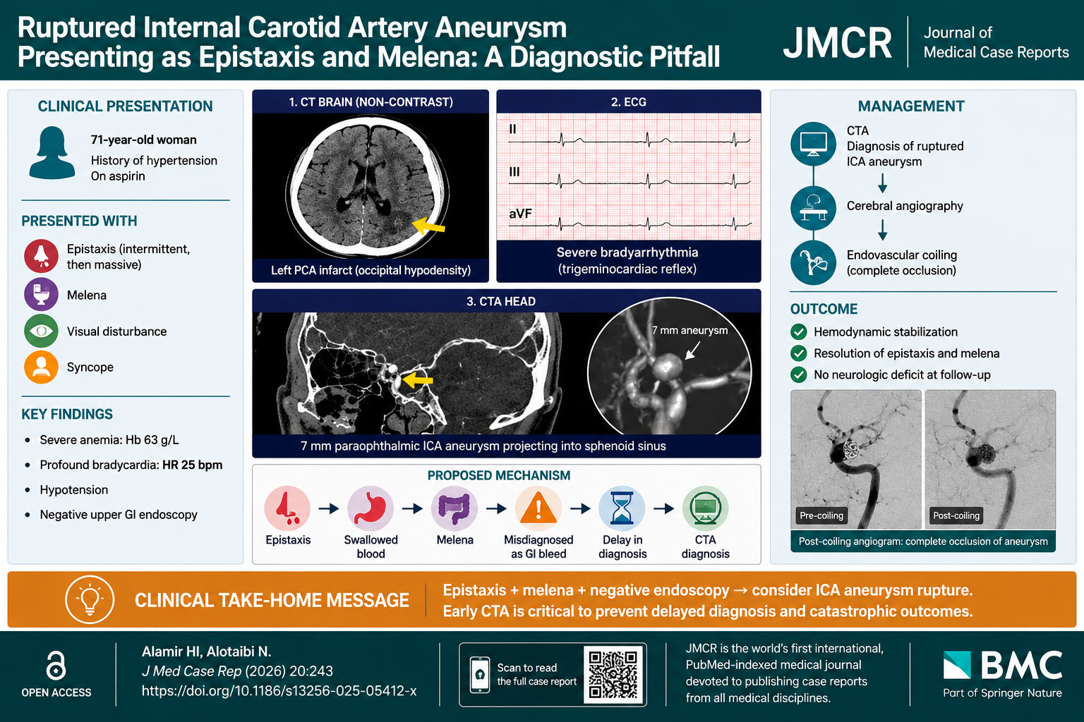 Ruptured Internal Carotid Artery Aneurysm Presenting as Epistaxis and Melena: A Diagnostic Pitfall