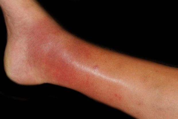 Swollen ankles: causes and management