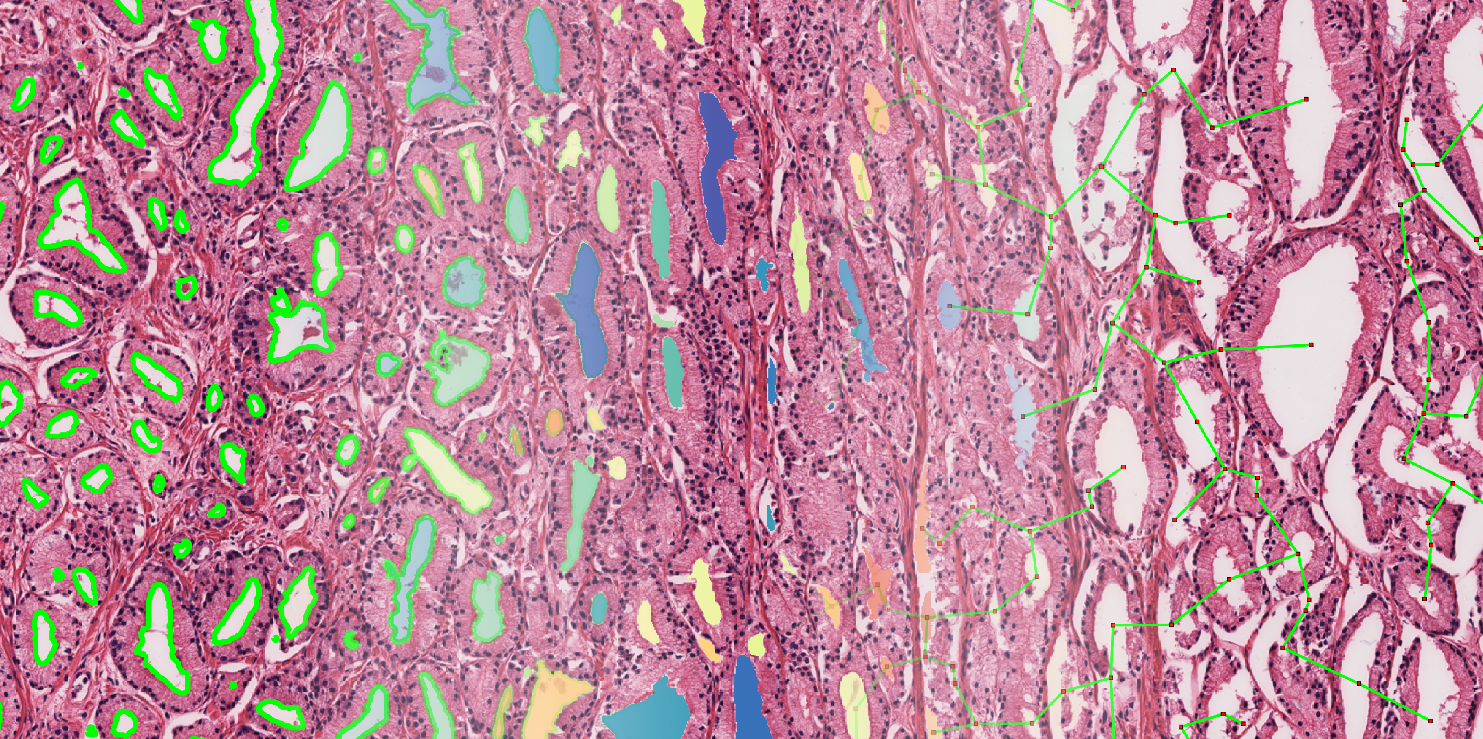 Machine learning on H&E slides could help identify patients that would benefit from additional therapy after surgery