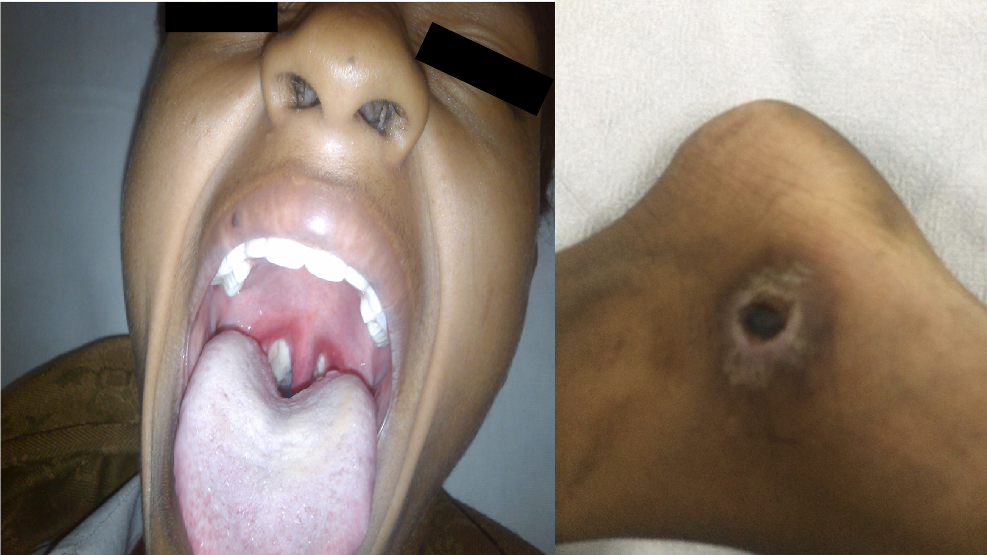 Diphtheria: A re-emerging major global threat