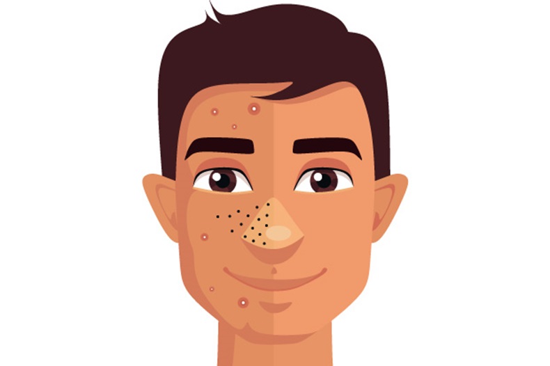 Nice guideline summary: Managing acne vulgaris 