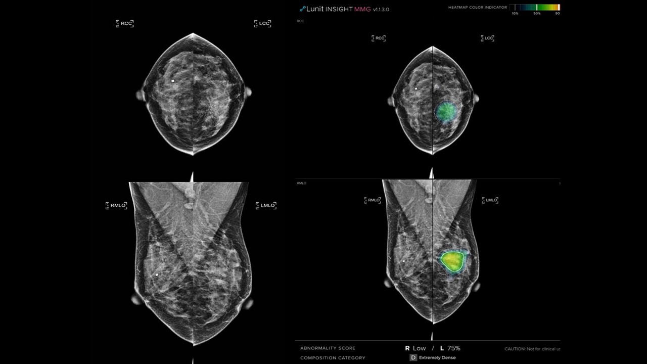 The AI-STREAM Study: AI is enhanced Breast cancer Screening
