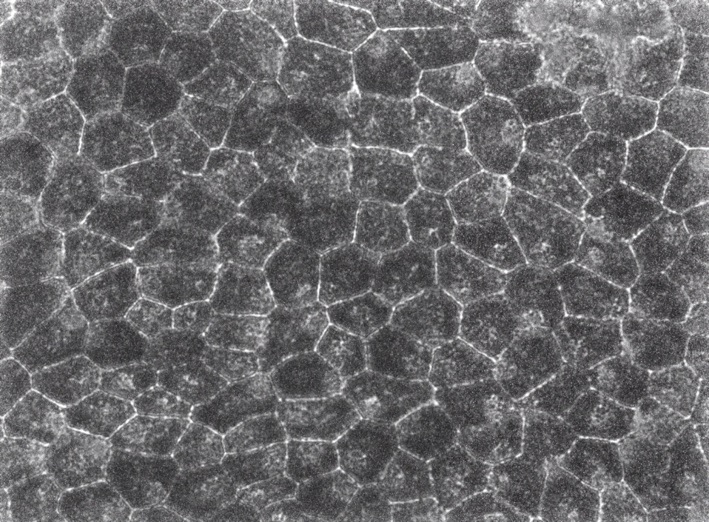 A cell patch for the treatment of blindness
