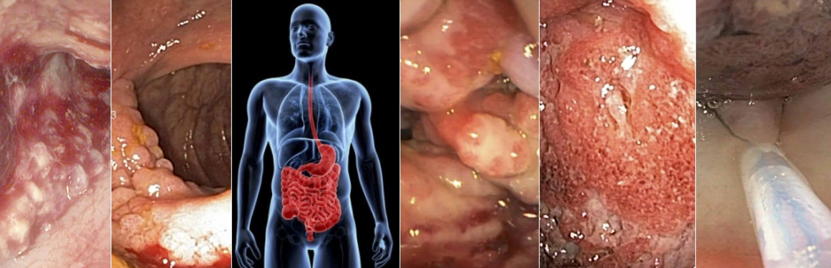 HyperKvasir: Data to enable AI for automated GI disease detection