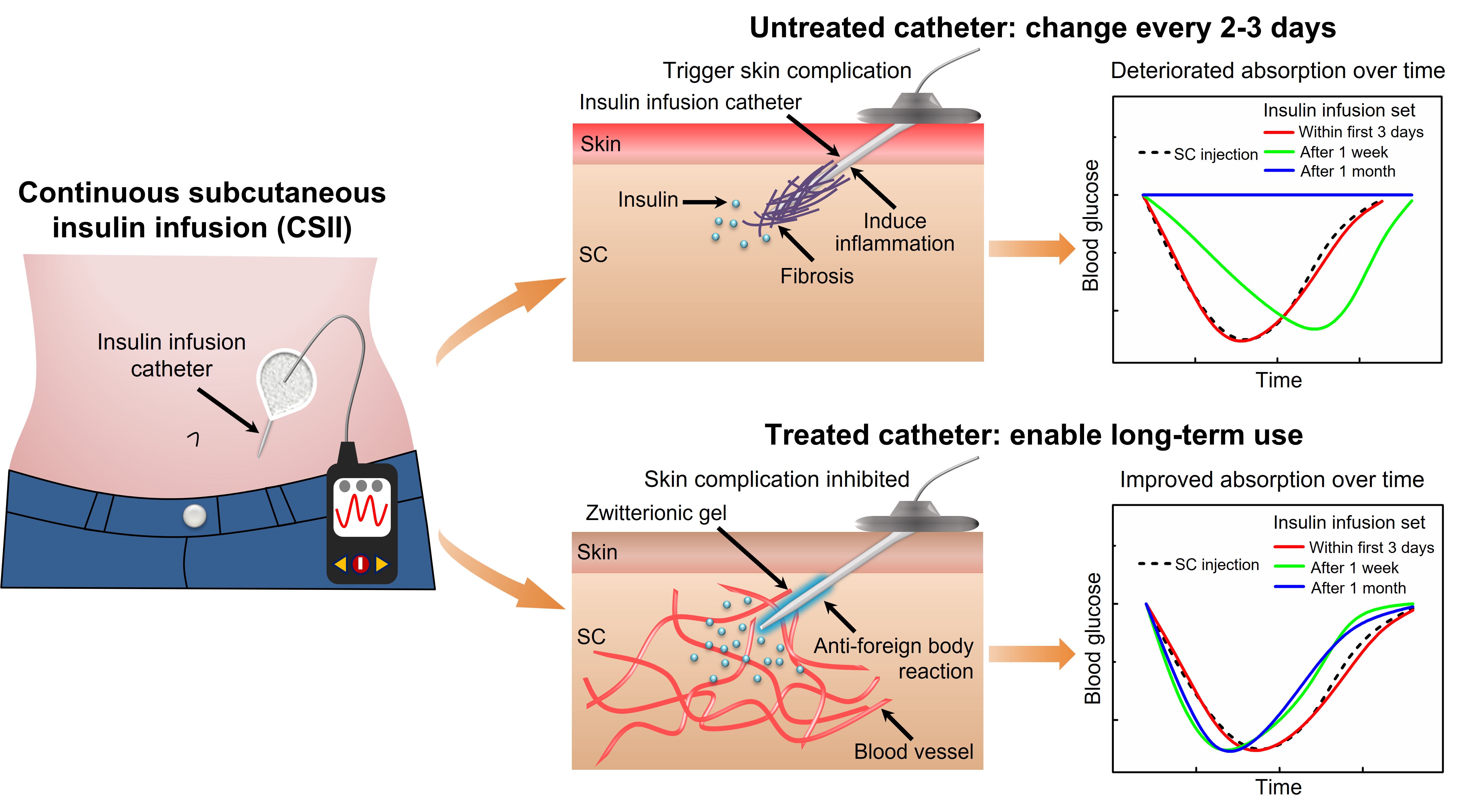 Zwitterionic “Implant Mate” enables long-term use of subcutaneous insulin infusion catheters and faster pharmaceutical absorption