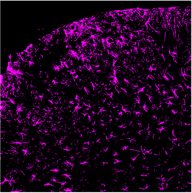 Chronic pain has a metabolic state: immunometabolic remodeling in the spinal cord