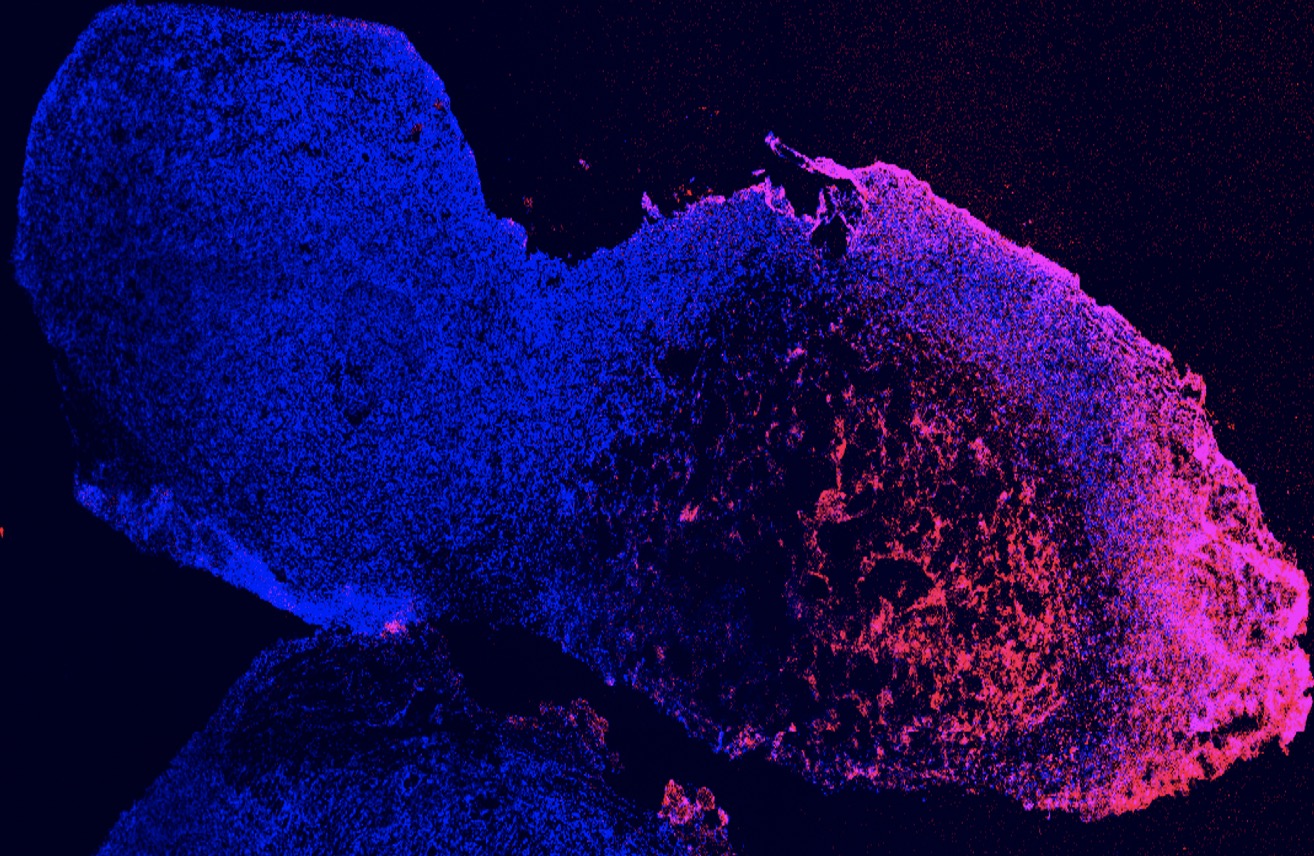 A one-shot combination therapy for triple-negative breast cancer