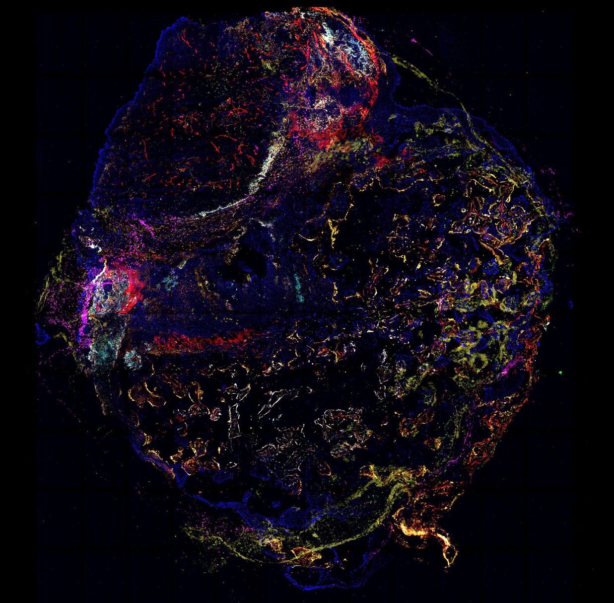 Engineered Humanized Microenvironments Expose the Awakening Tumor Niche