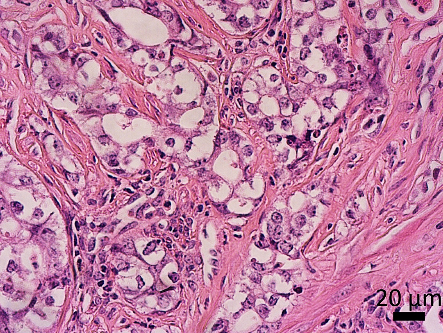 Novel poorly differentiated endometrial cancer mouse model