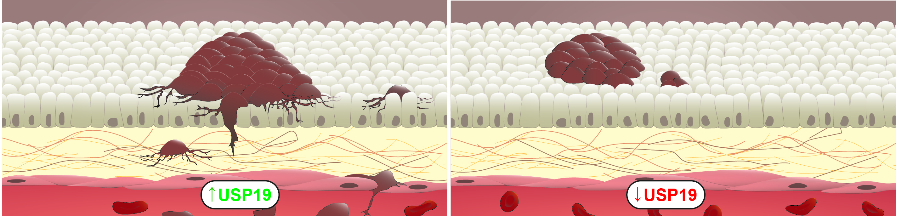 USP19 modulates cancer cell migration and invasion and acts as a novel prognostic marker in patients with early breast cancer