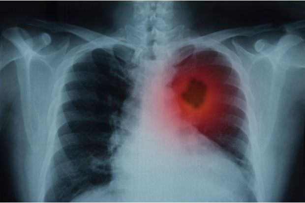 Chronic obstructive pulmonary disease: risk factors and diagnosis