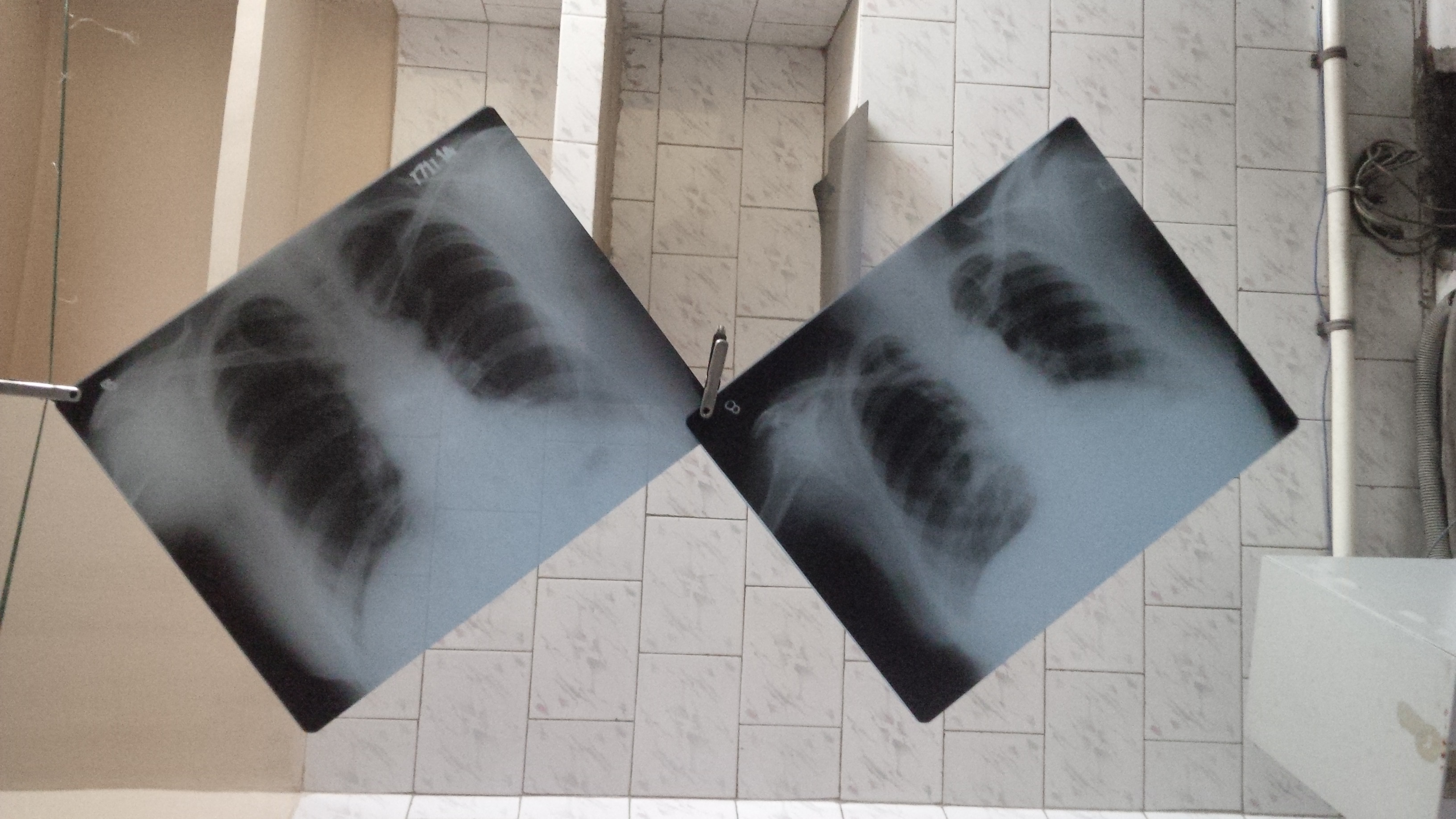 Chest radiography in tuberculosis detection 