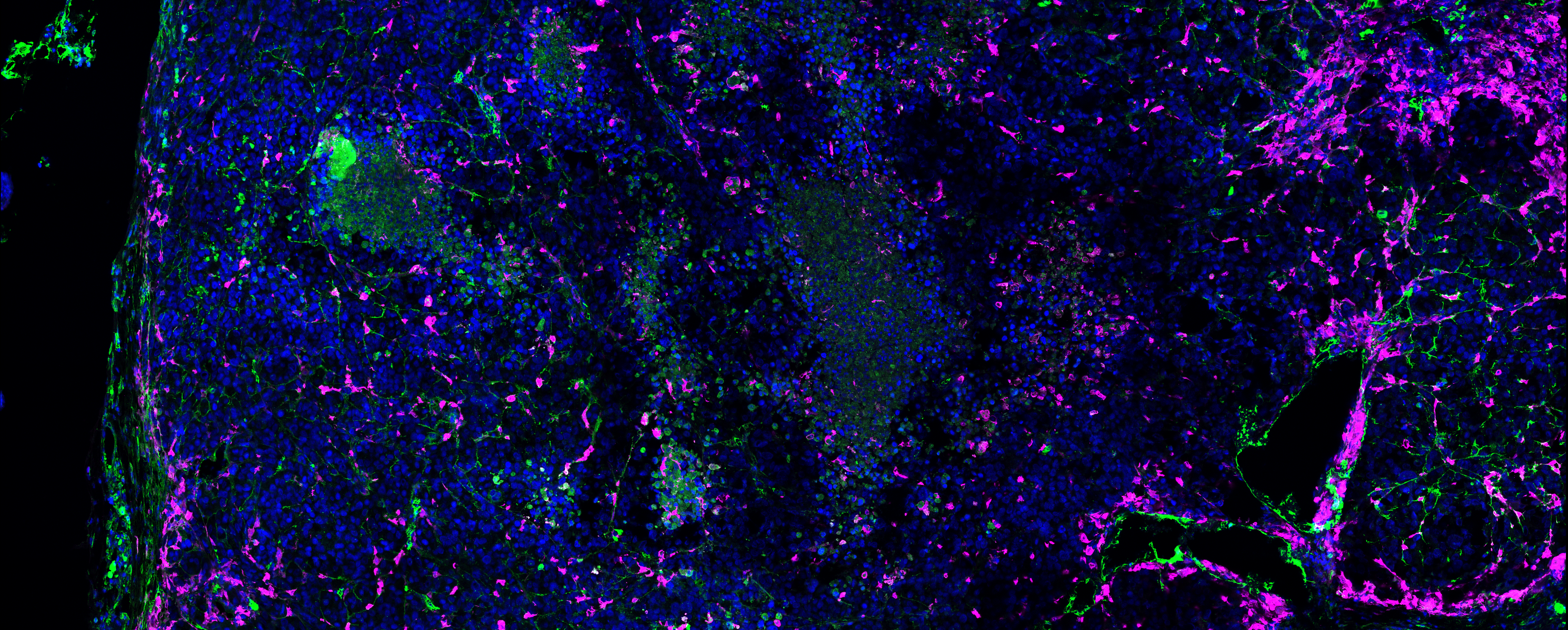 MIDKINE REPROGRAMS ANTI-TUMOR IMMUNITY AND PROMOTES IMMUNOTHERAPY RESISTANCE IN CANCER PATIENTS