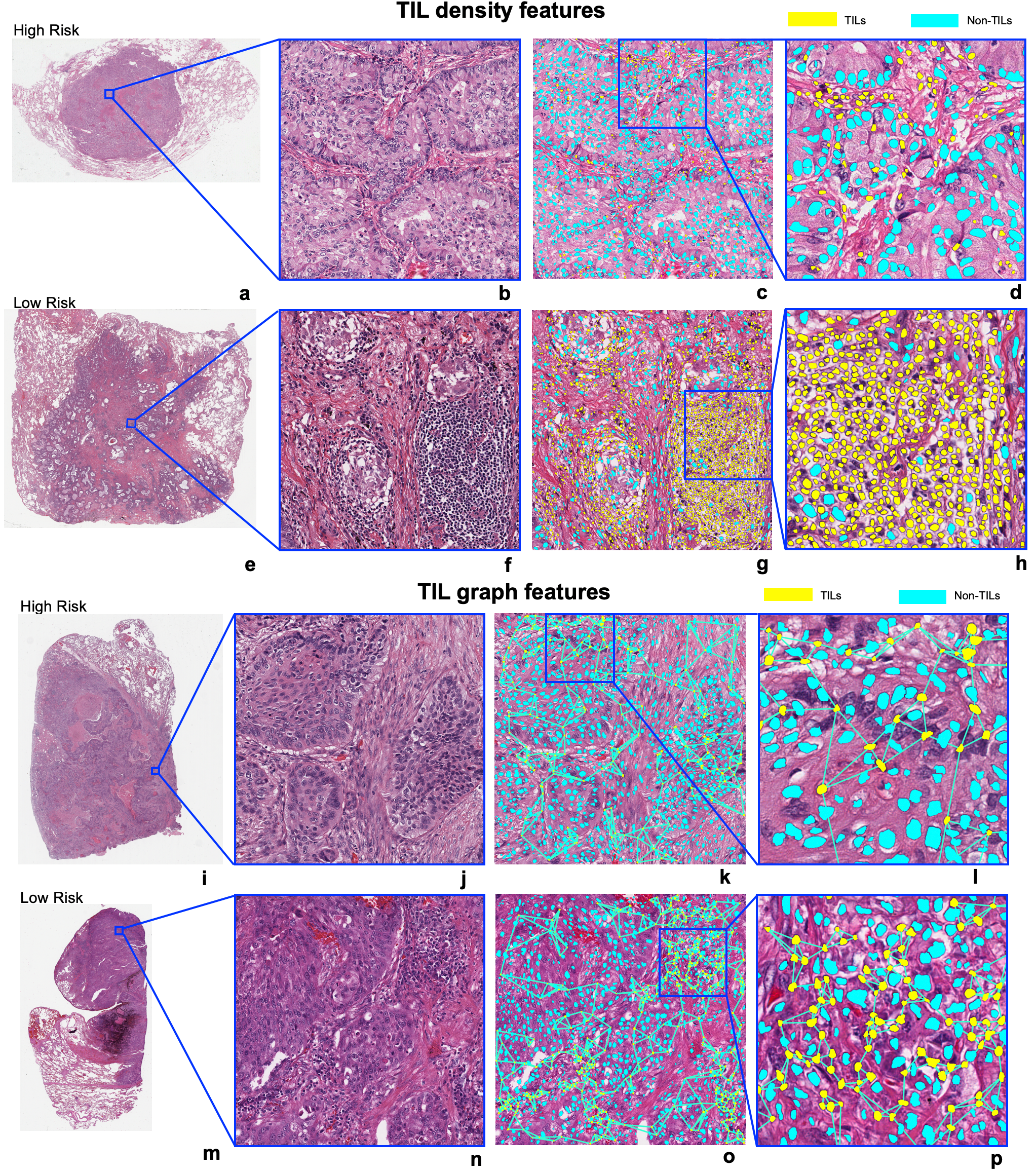 Image Analysis Reveals Molecularly Distinct Patterns of TILs in NSCLC associated with Treatment Outcome