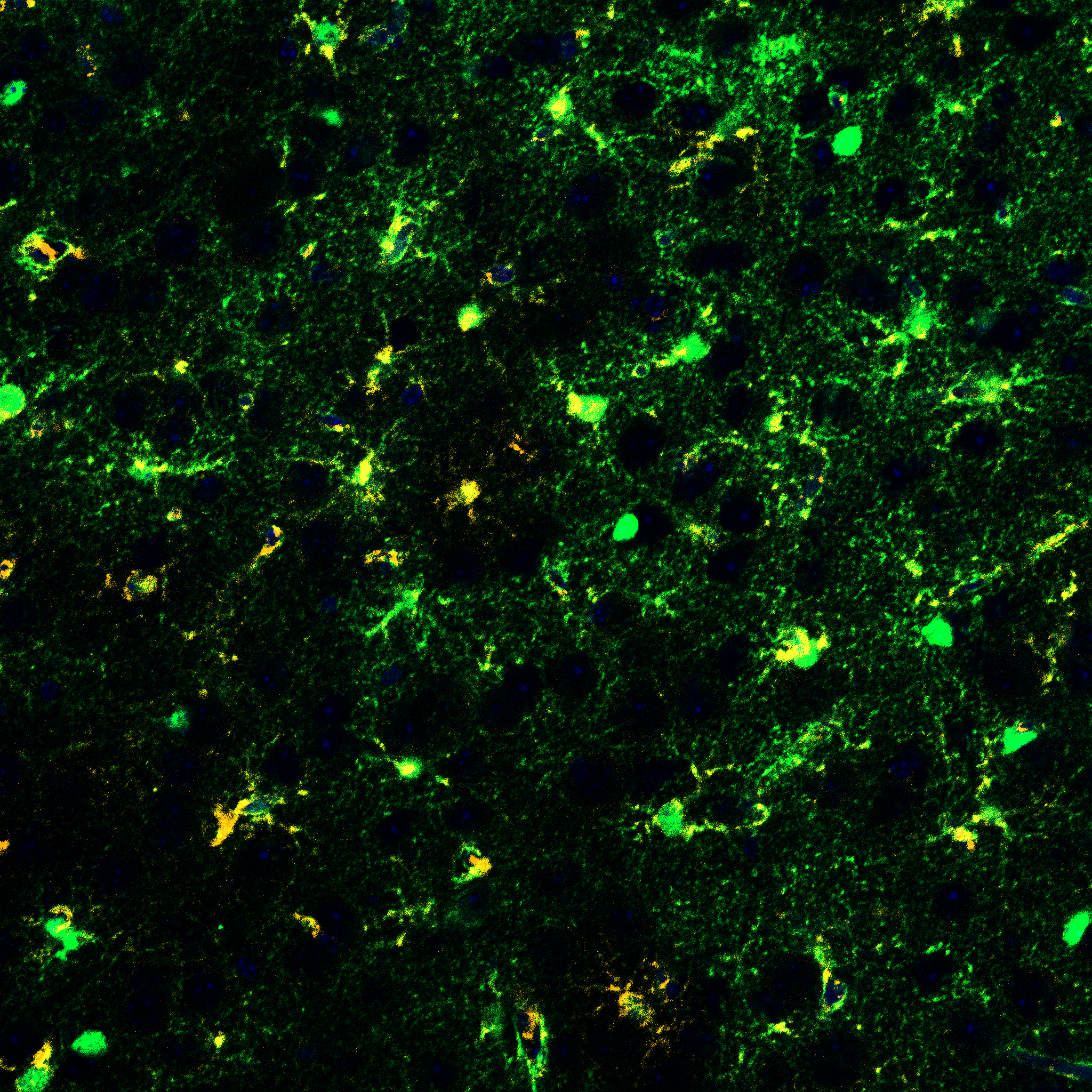 A metabolic switch in astrocytes converts nociceptive injury into persistent pain