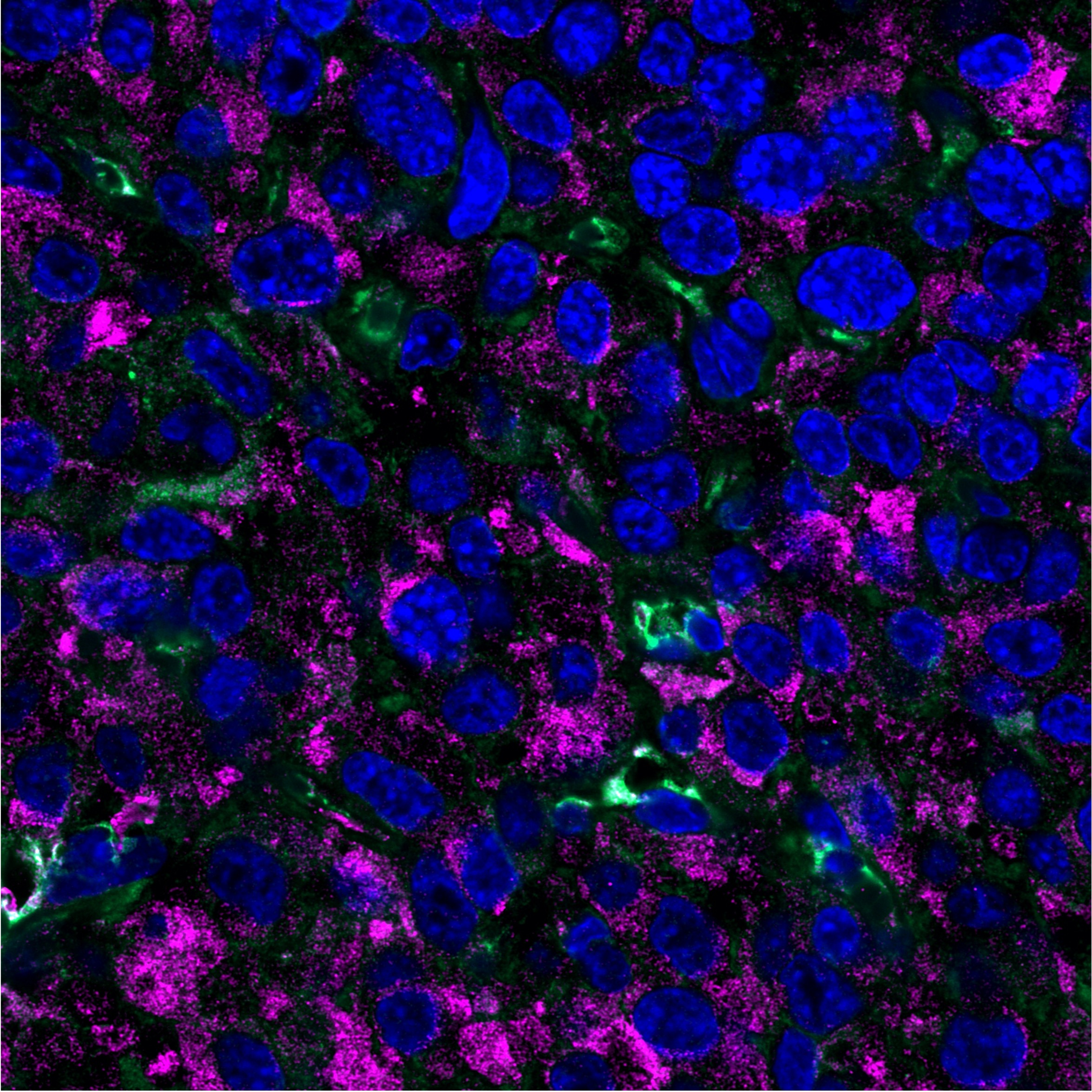 Targeting cellular stress response to overcome chemoresistance in glioblastoma
