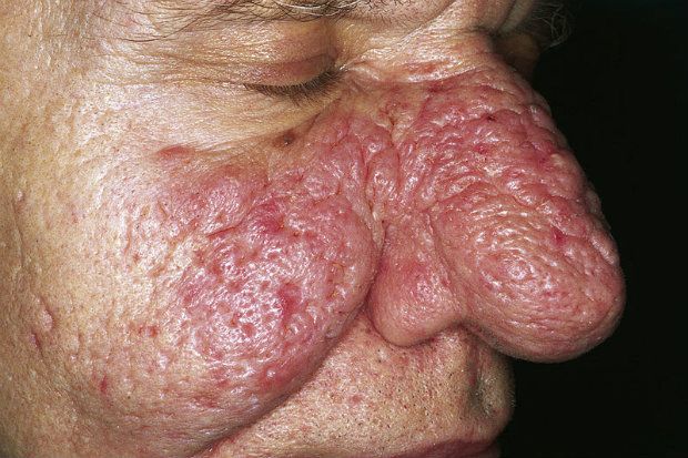 Can you treat this bulbous nose?