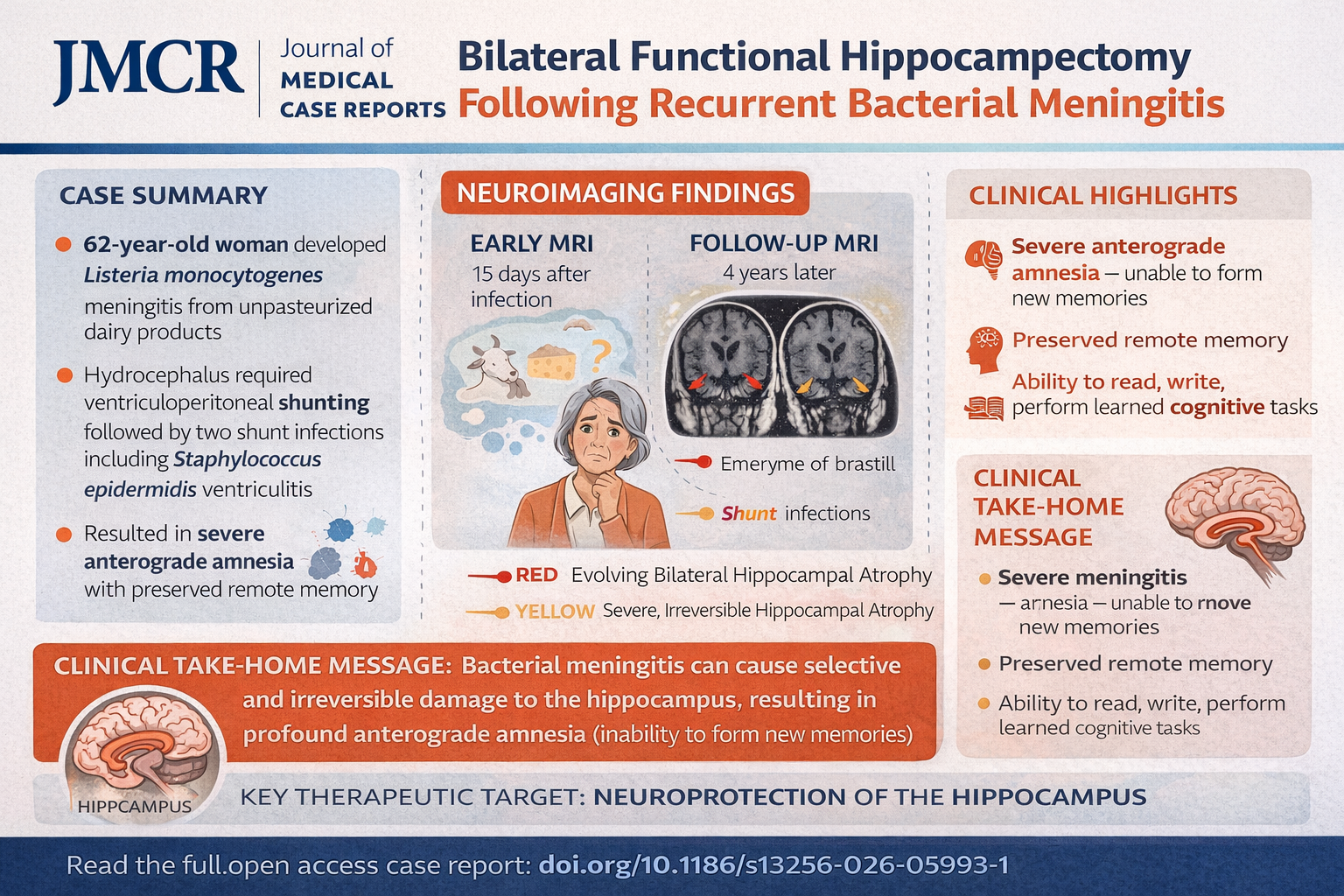 Bilateral Functional Hippocampectomy Following Recurrent Bacterial Meningitis: When Infection Erases Memory Formation