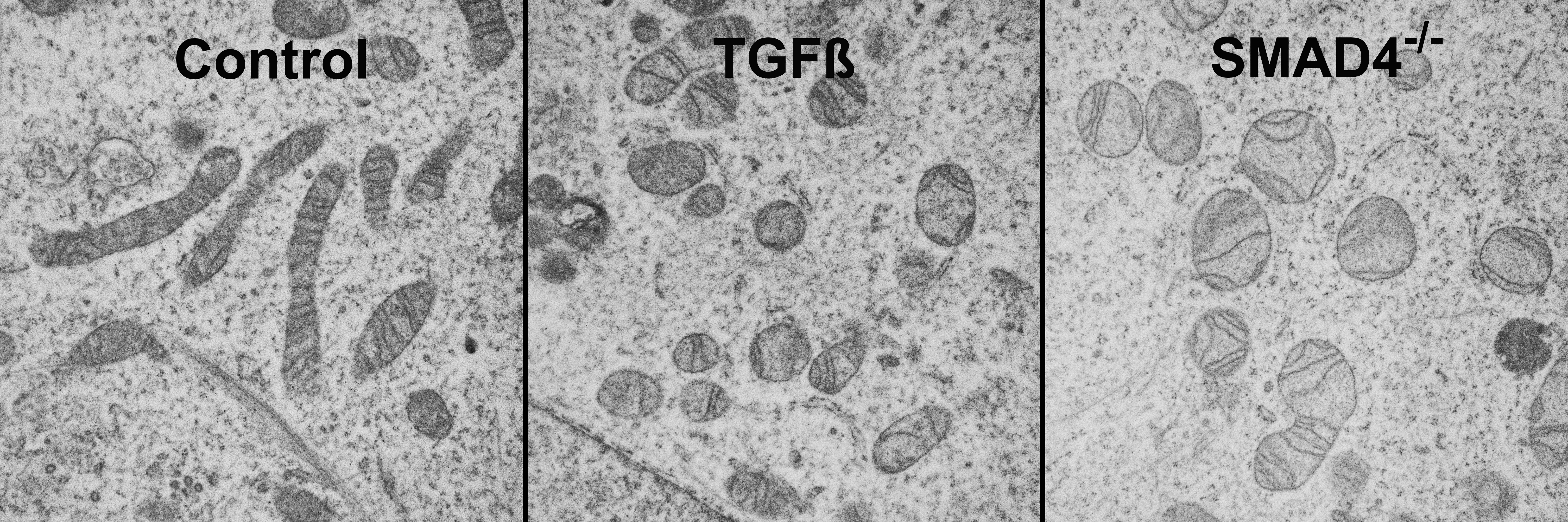 Paradoxical role of SMAD4 loss in pancreatic cancer
