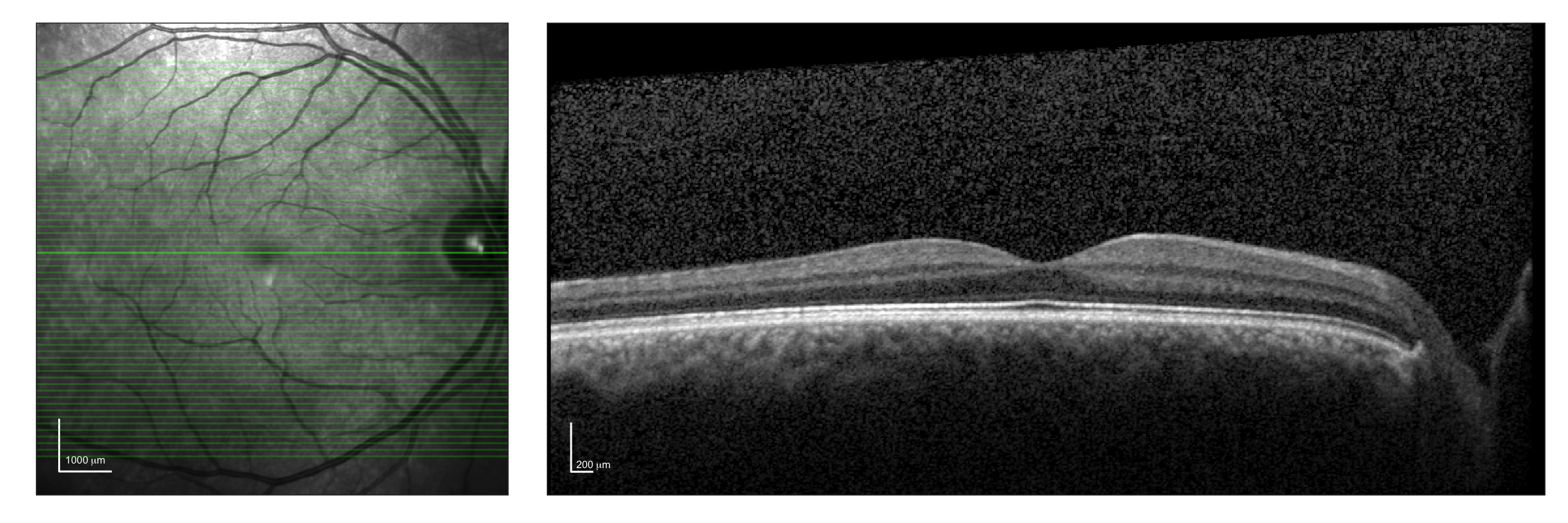 Estimating photoreceptor cell survival using clinical images