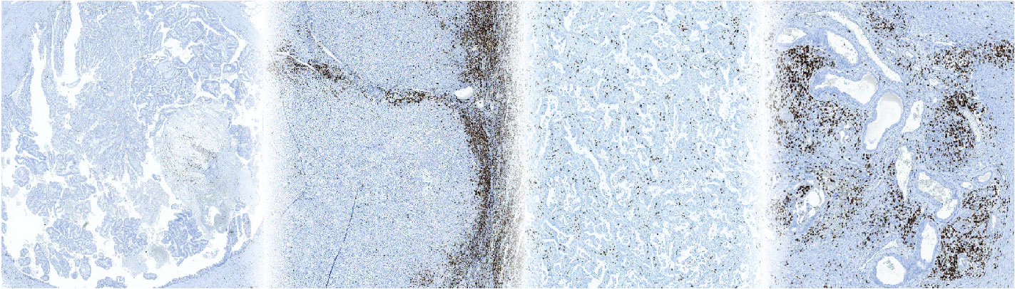 From patients to tumor avatars: A journey towards personalized immunotherapy research