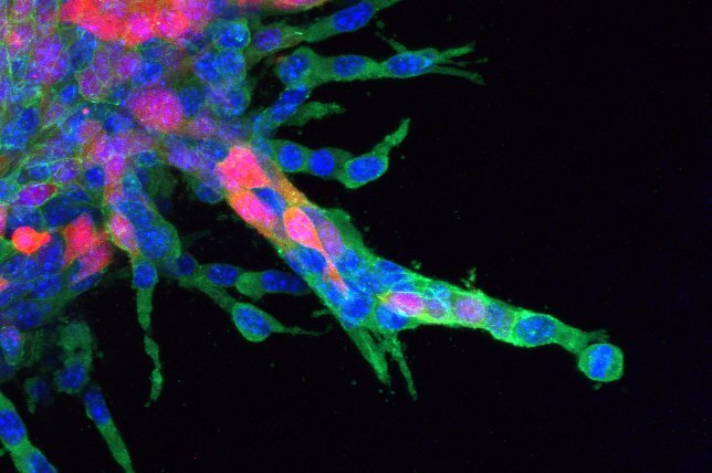 Invadopodia and cooperative metastasis