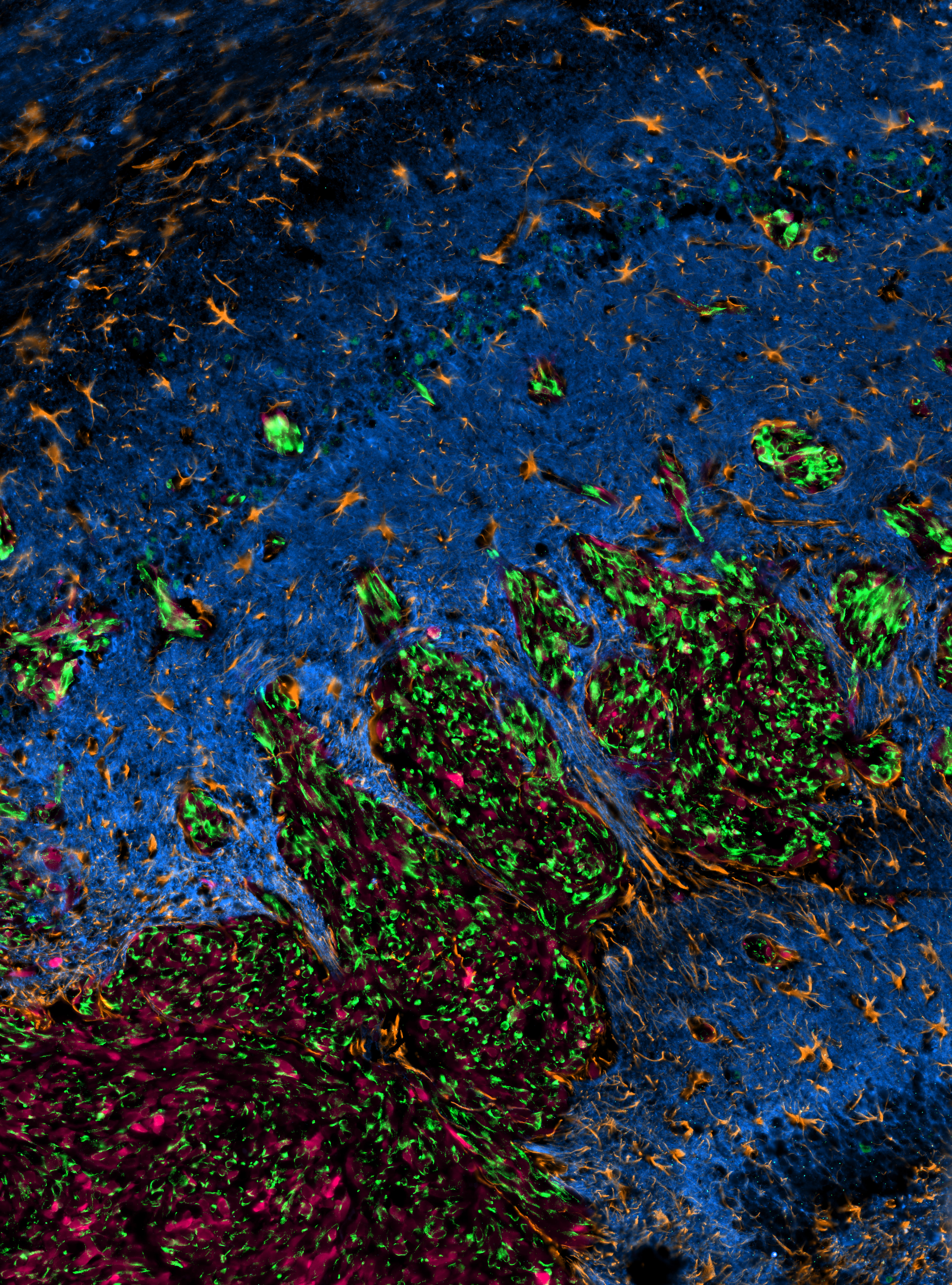 A designer peptide against the EAG2–Kvβ2 potassium channel targets the interaction of cancer cells and neurons to treat glioblastoma
