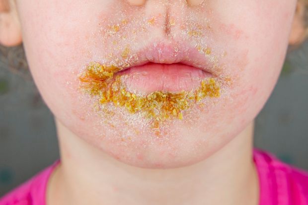 Impetigo: causes, symptoms and diagnosis