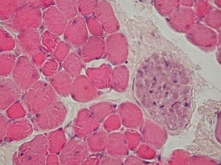 Answers Where Few Exist: Measuring Oxidative Stress to Screen Therapies for SELENON-Congenital Myopathy