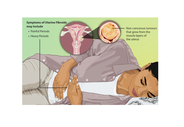 Fibroids: The Reality Behind the Diagnosis