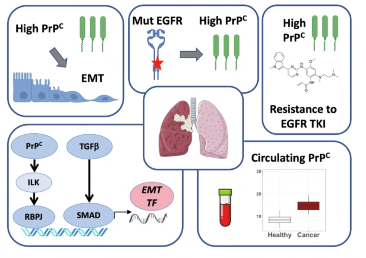 PrPC controls epithelial-to-mesenchymal transition in EGFR-mutated NSCLC: implications for TKI resistance and patient follow-up