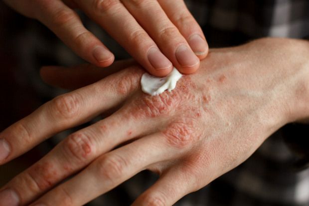 Is this reclassified medicine an option for psoriasis?