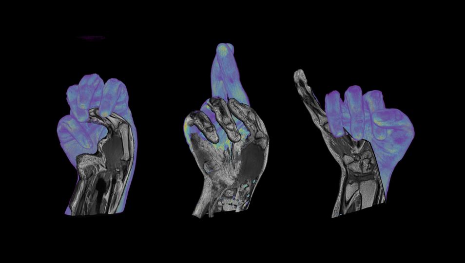MRI detectors that fit like a glove