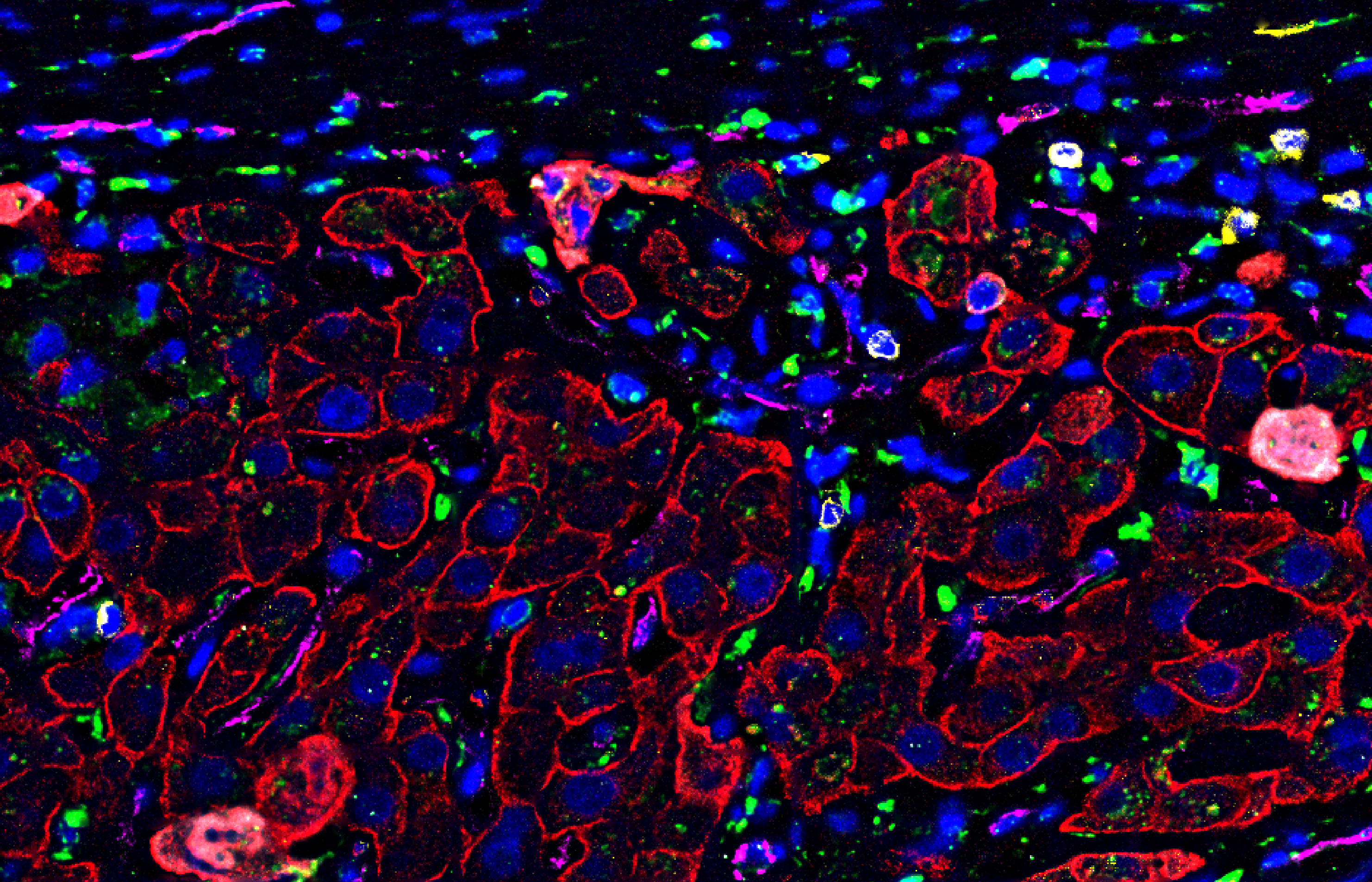 Behind Enemy Lines: How Cancer Persists by Hiding from our Immune System