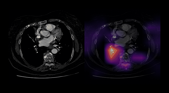 
PENet—a scalable deep-learning model for automated diagnosis of pulmonary embolism using volumetric CT imaging