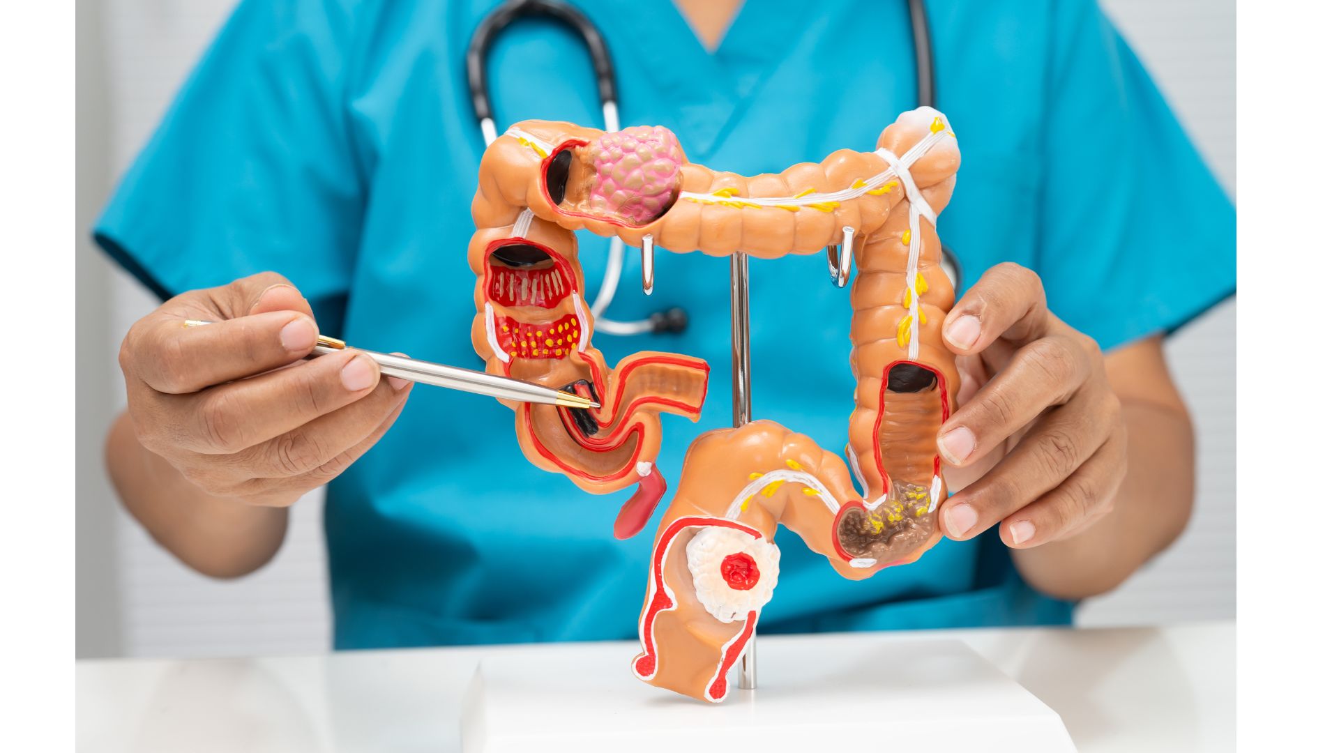 Research Proposal: The Impact of Socioeconomic Deprivation on Phenotype and Clinical Outcomes in Inflammatory Bowel Disease: A UK IBD BioResource Study