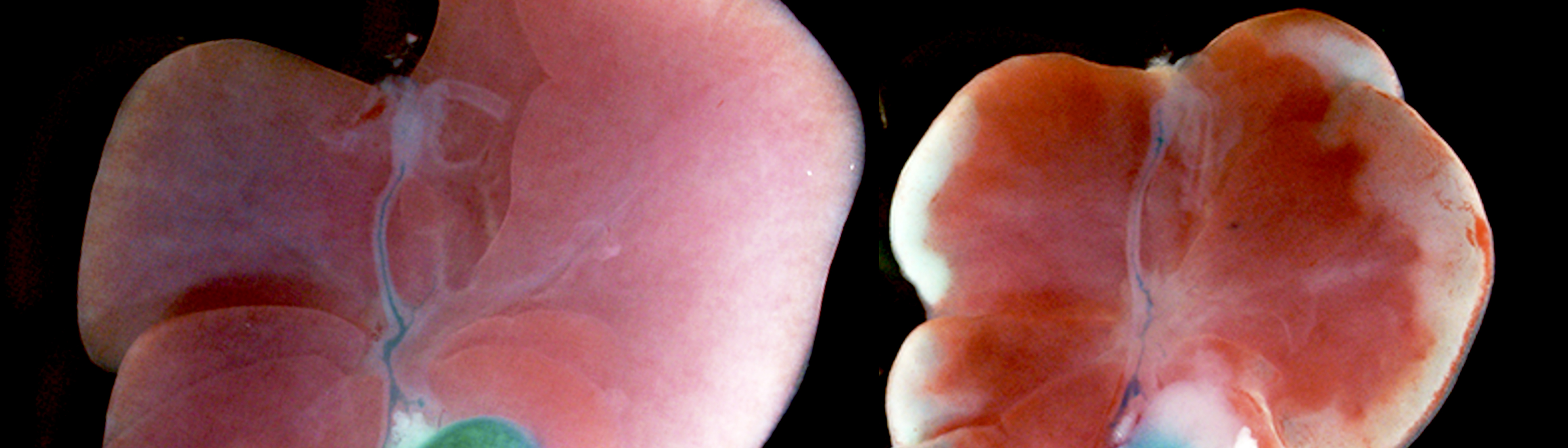 Impact of Gallbladder Hypoplasia on Hilar Hepatic Ducts in Biliary Atresia