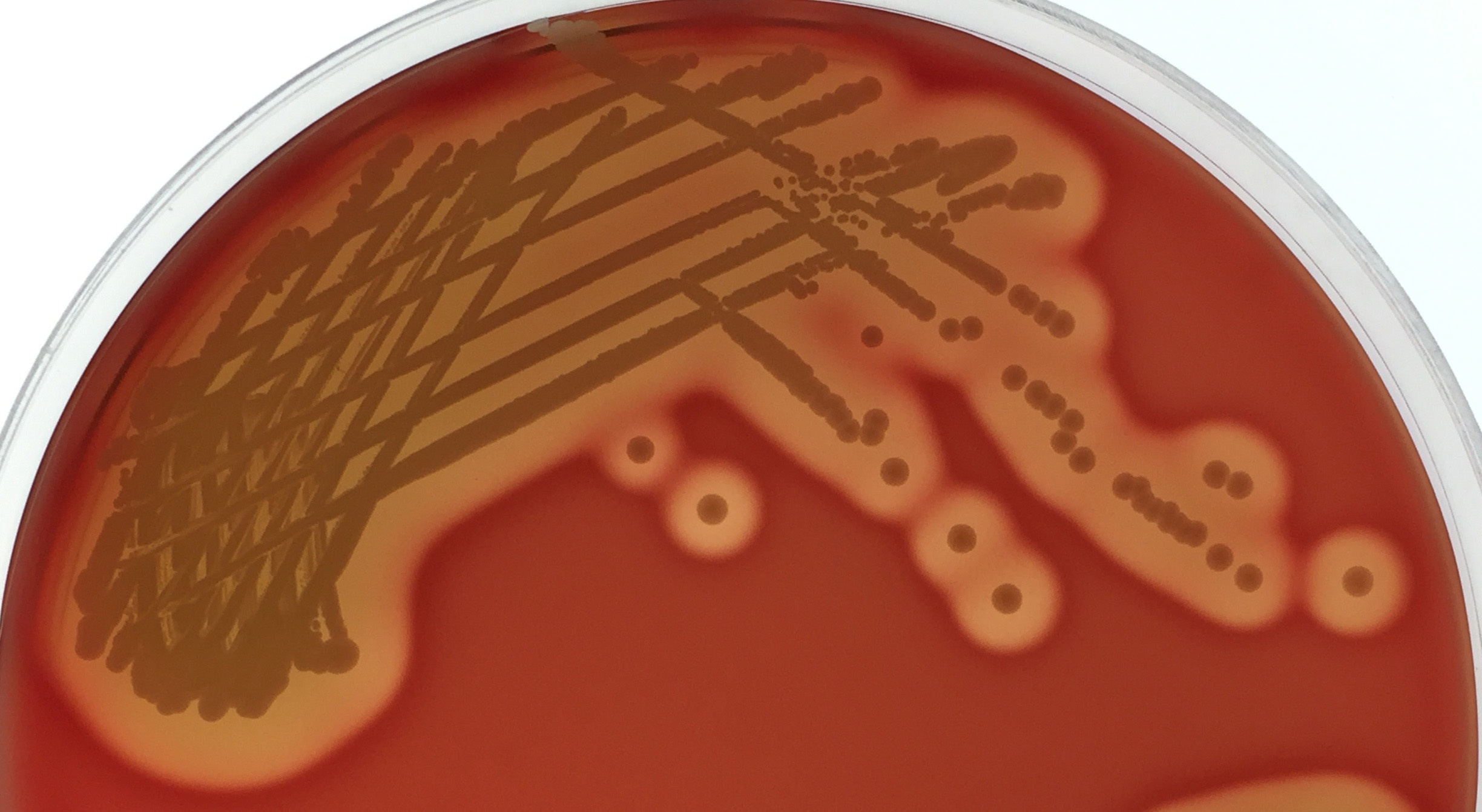 Commensal to commander – the global spread of multidrug-resistant Staphylococcus epidermidis