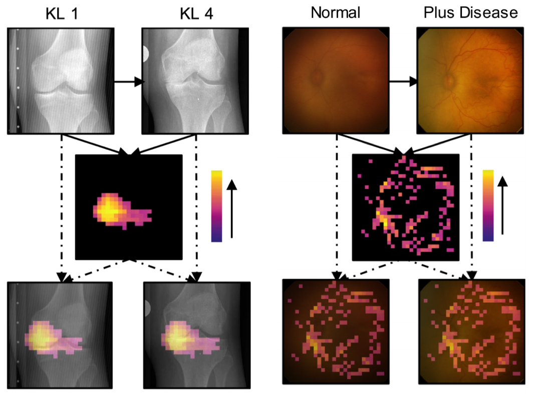 Siamese neural networks for continuous disease severity evaluation and change detection in medical imaging