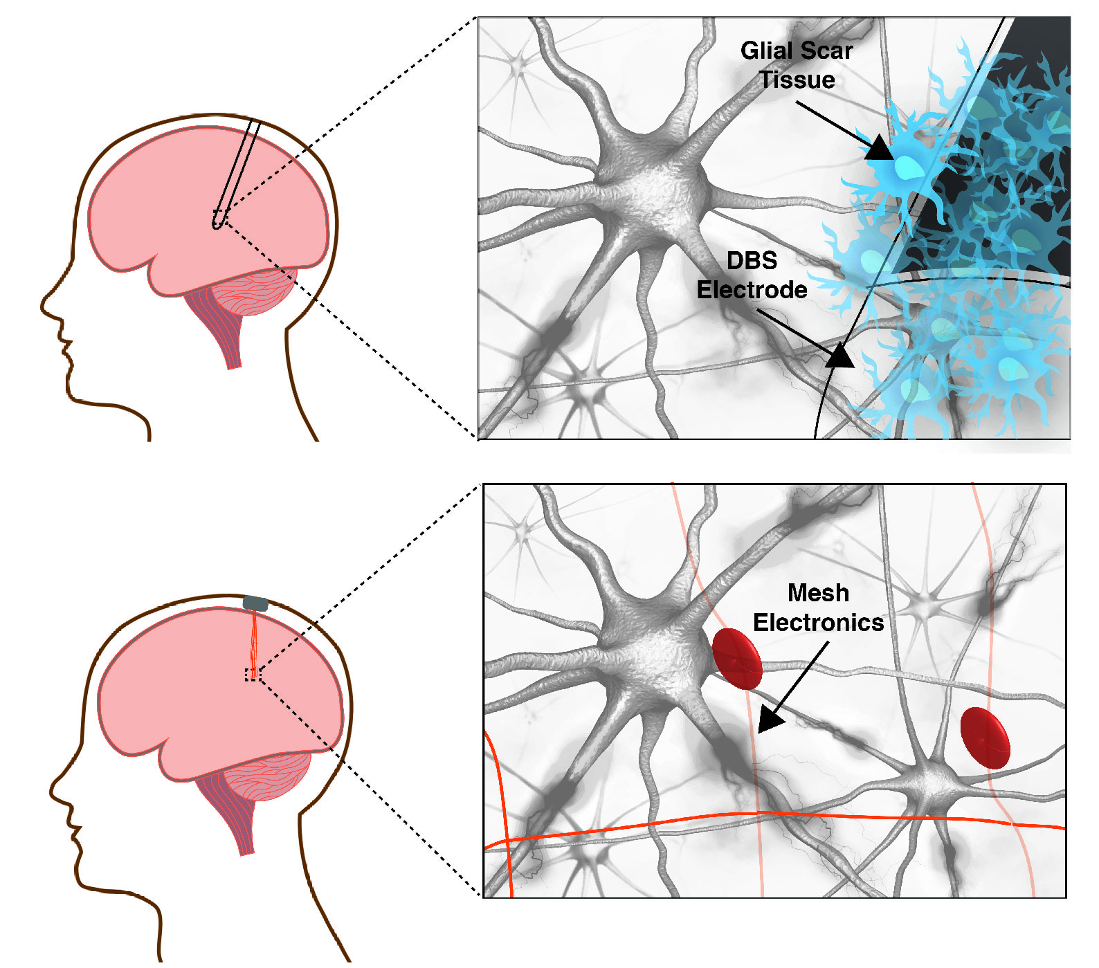 Precision electronic medicine in the brain