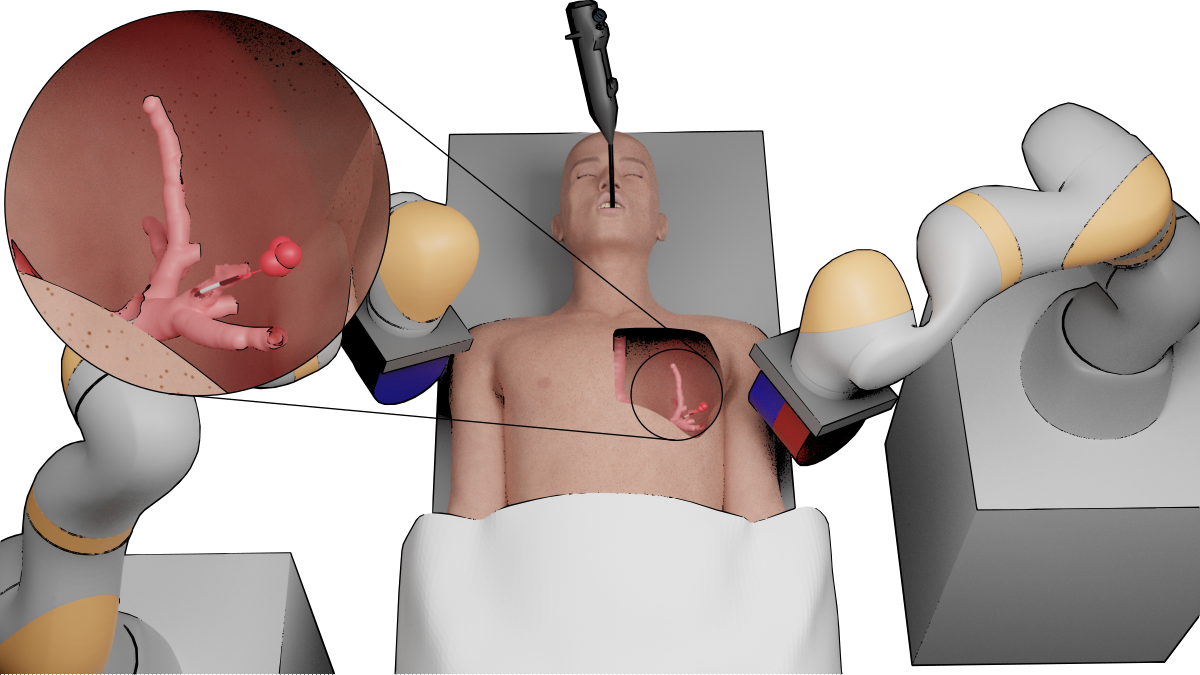 Personalized magnetic tentacles for targeted photothermal cancer therapy in peripheral lungs