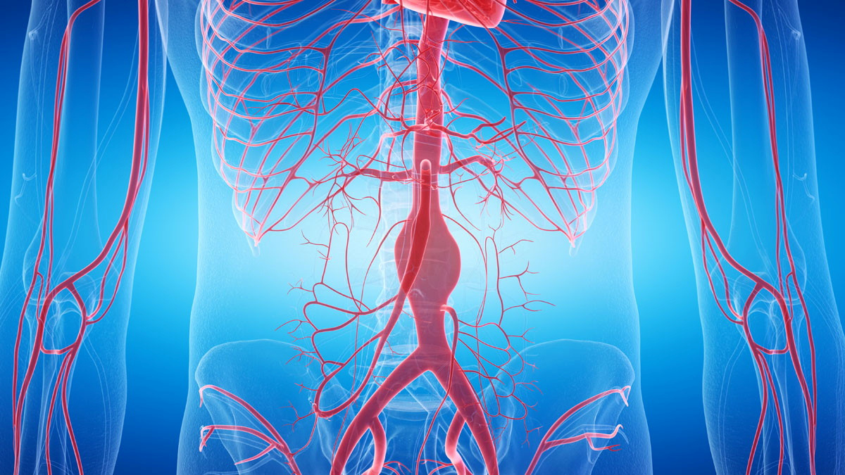 Continue exploring - Aortic aneurysm and dissection management Collection