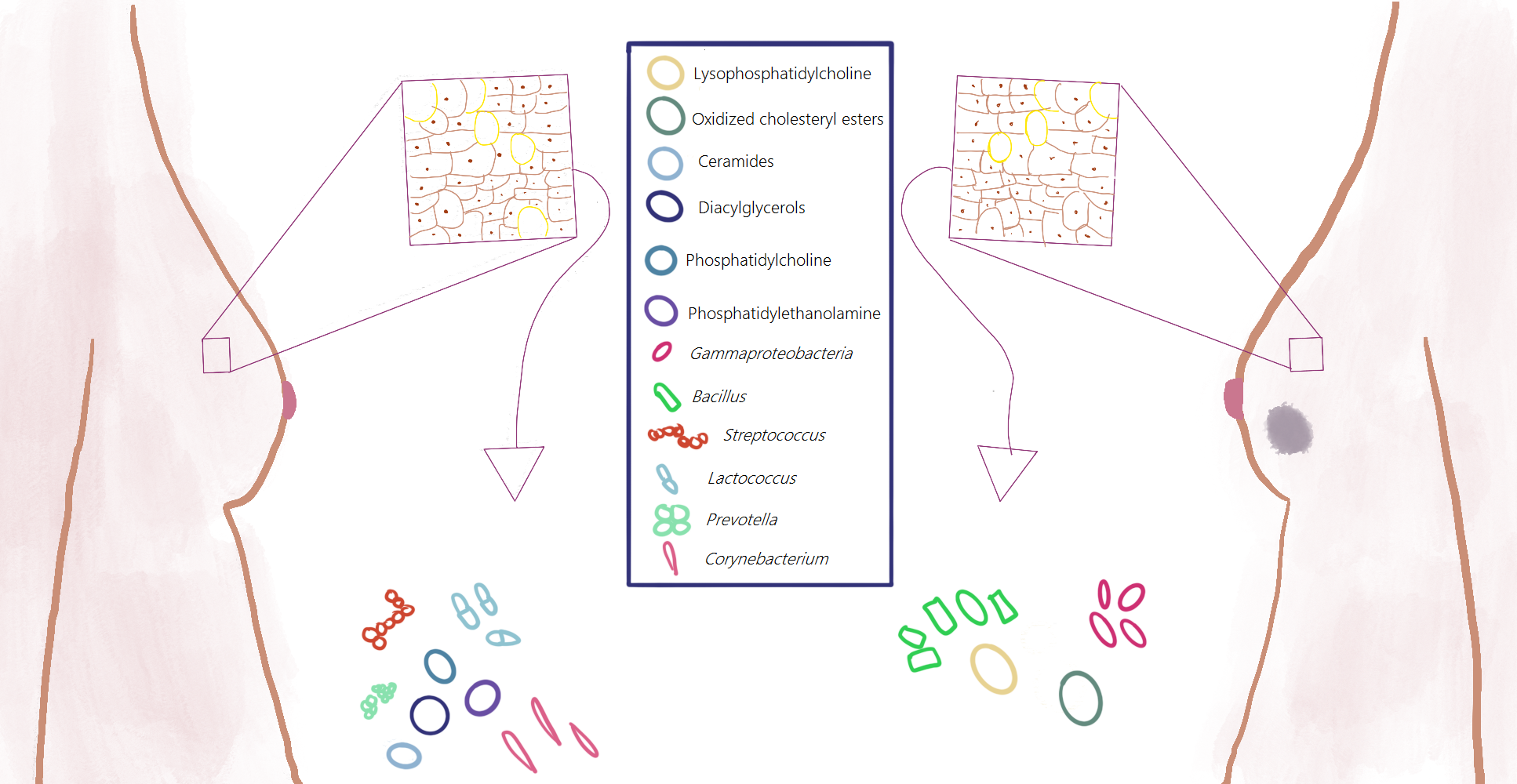 Microbes and lipids: new insights into the breast cancer puzzle