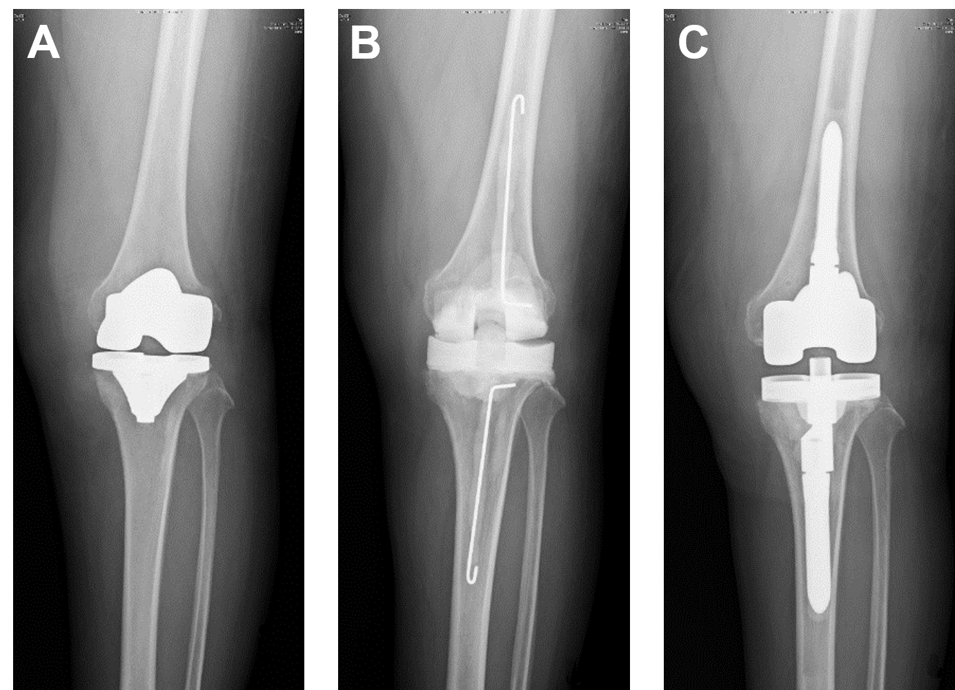 Development of a multiplex and sensitive lateral flow immunoassay for clinical diagnosis