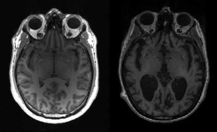 Leveraging AI and Neuroimaging to Uncover Early Signs of Alzheimer's Disease