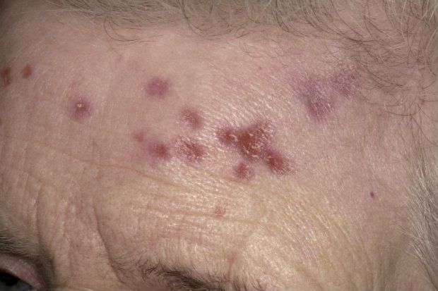 Sarcoidosis